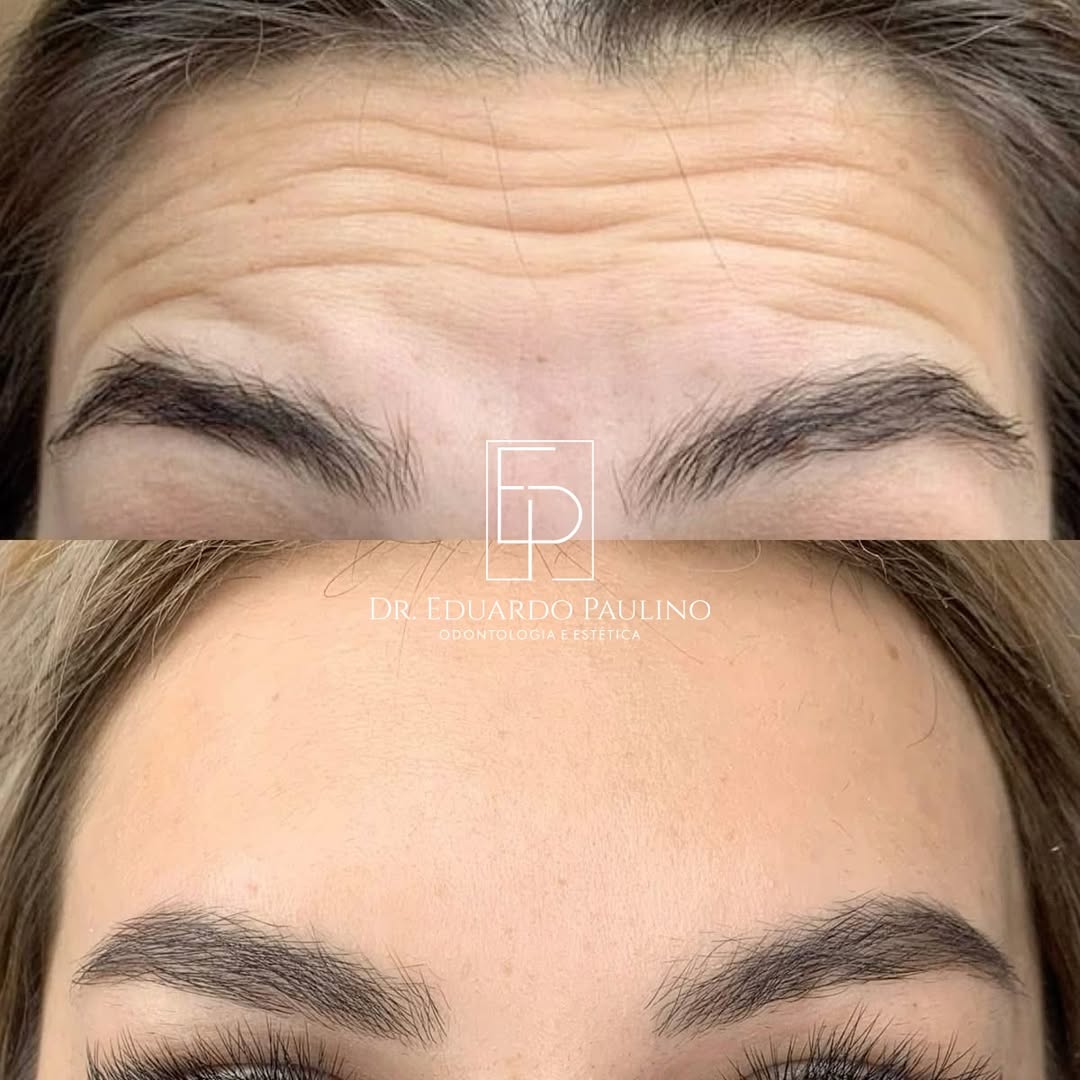 Toxina Botulínica — antes e depois